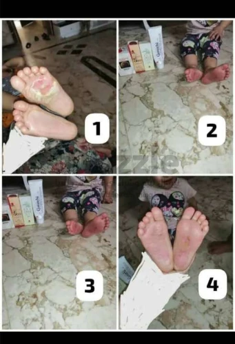 التشافي من جميع الأمراض الجلدية بمنتجات Dxn