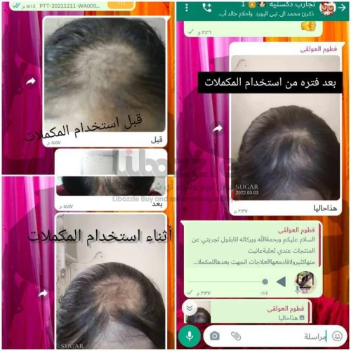 حالة تشافي من الثعلبة باستخدام منتجات DXN